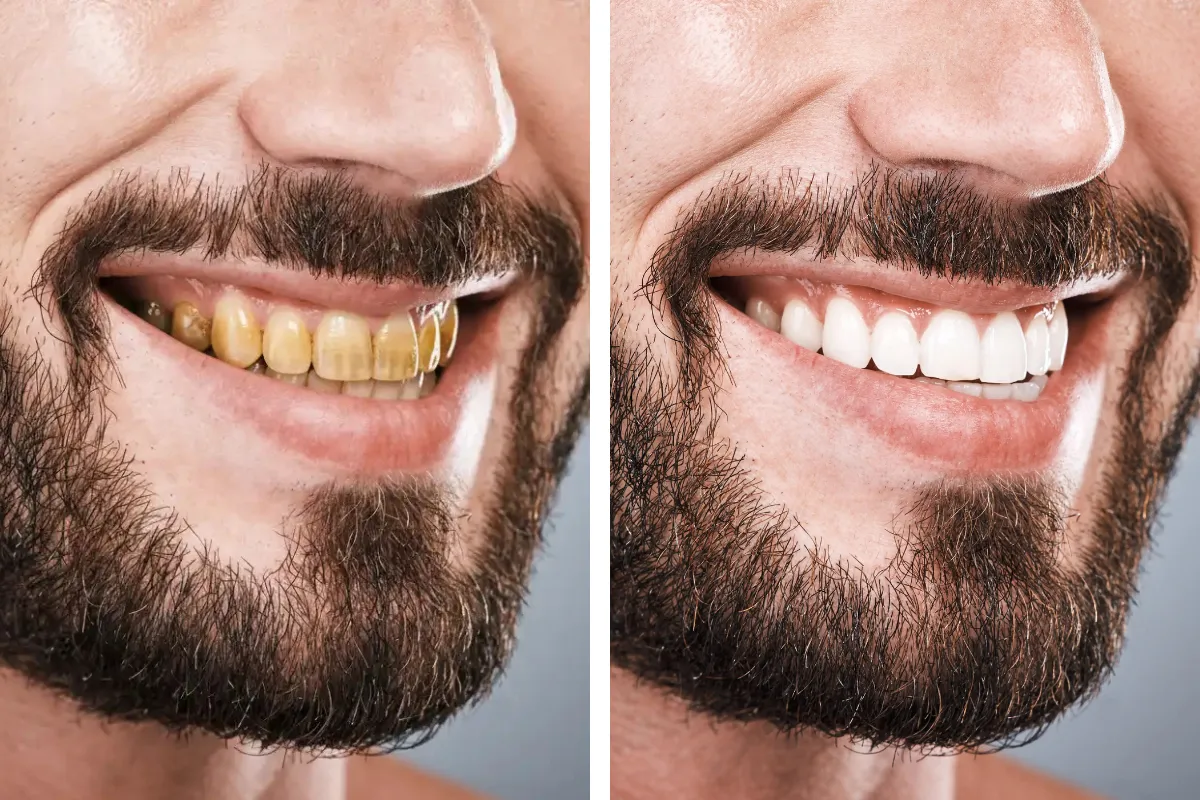 تبييض الأسنان للمدخنين: صورة قبل وبعد تُظهر الفرق بين الأسنان المصفرة بسبب التدخين والأسنان البيضاء بعد التبييض