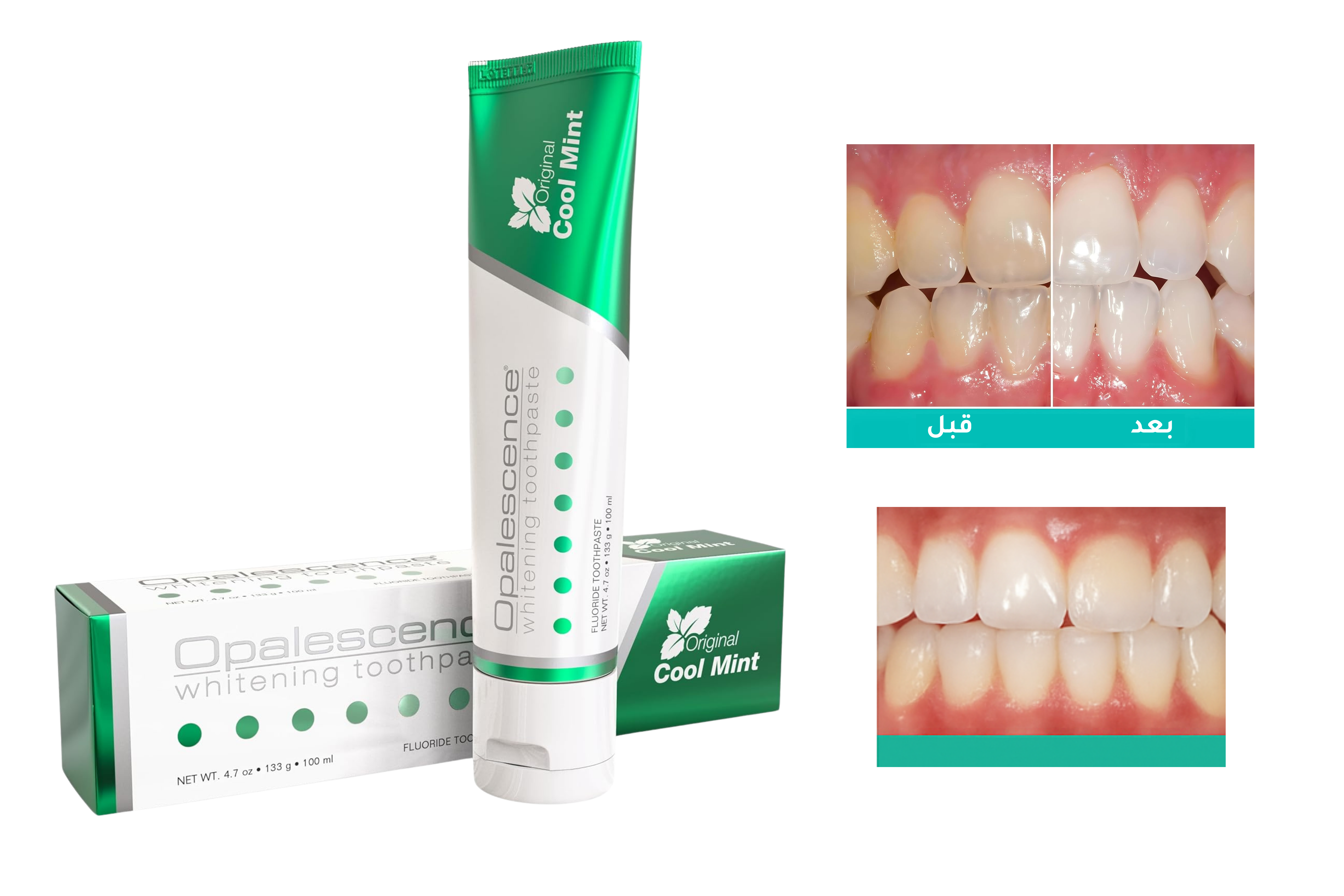 معجون Opalescence لتبييض الأسنان في المنزل بنكهة النعناع مع نتائج قبل وبعد: أفضل منتجات تبييض الأسنان في المنزل