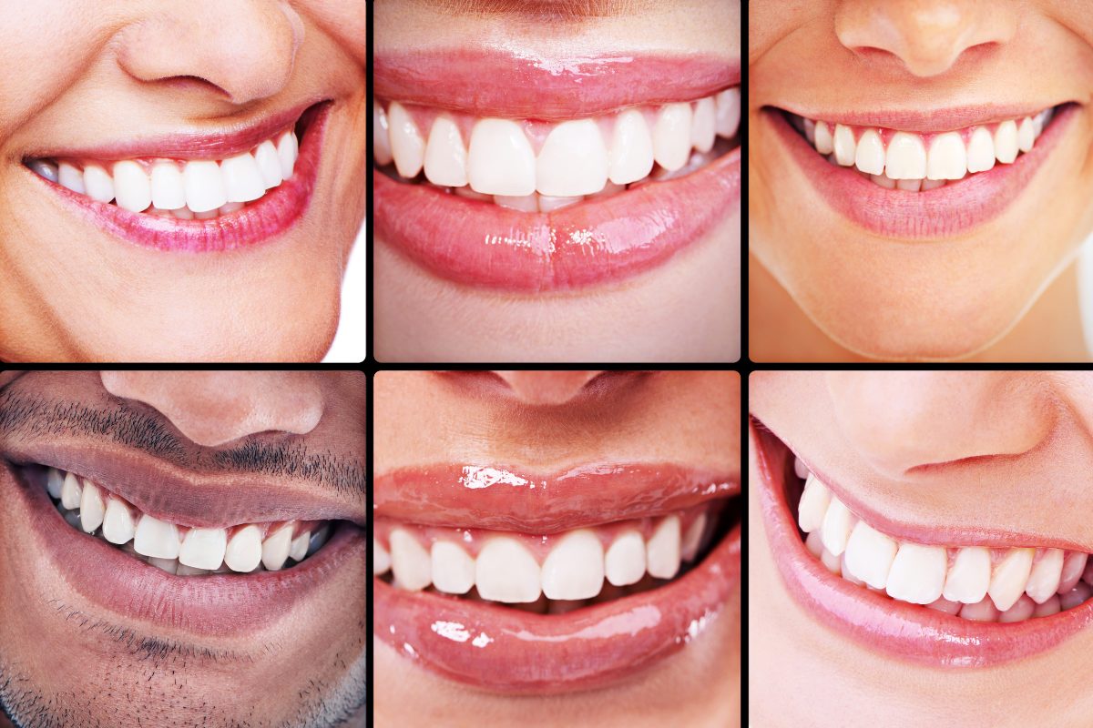 "ابتسامات بأسنان بيضاء وصحية توضح نتائج منتجات تبييض الأسنان – هل تبييض الأسنان في المنزل آمن"